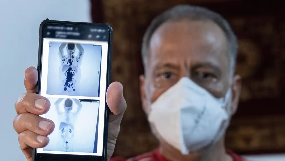 Paulo Peregrino muestra dos resonancias magnéticas de su torso durante una entrevista con EFE, el 5 de junio de 2023. Los estudios experimentales con CAR-T se realizan con fondos públicos a través de la fundación Hemocentro de la Universidad de Sao Paulo