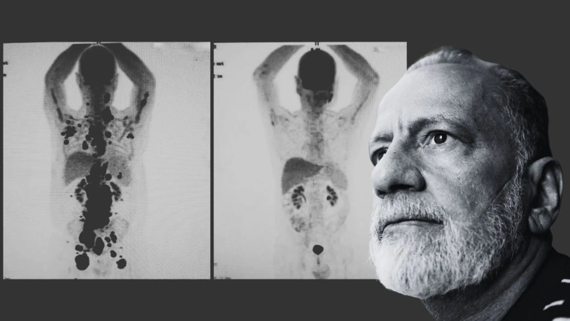 Paulo Peregrino cáncer un mes CAR-T Brasil