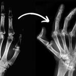 Mano izquierda con artritis