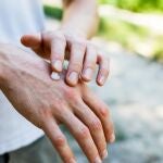 Psoriasis