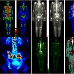 El cáncer de próstata es una de las enfermedades más comunes entre estos tumores
