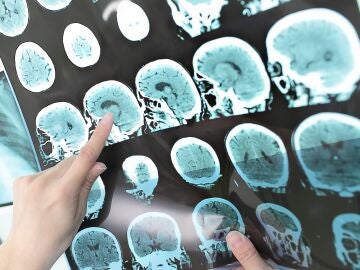 Radiograf&iacute;a de esclerosis m&uacute;ltiple.