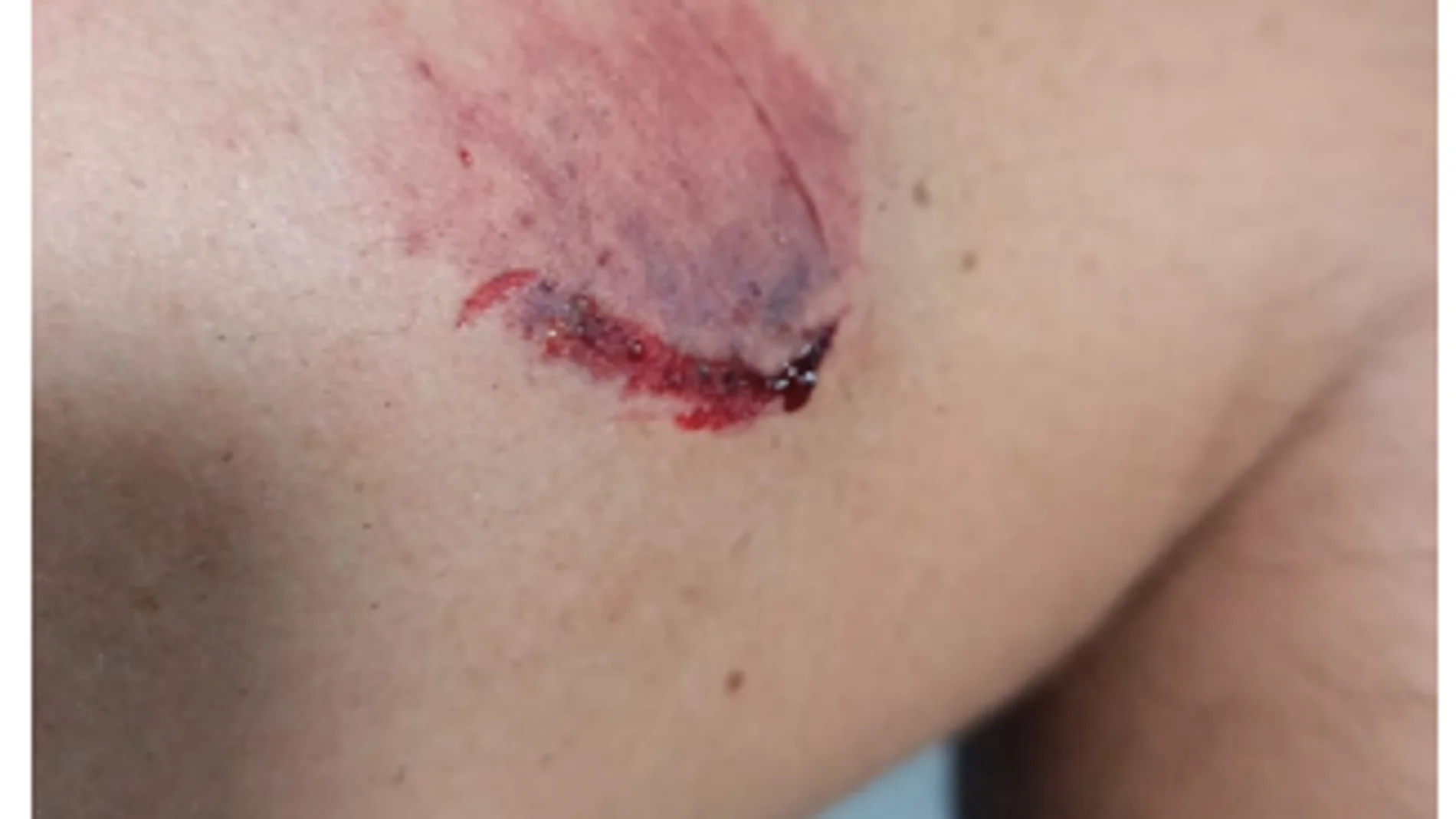 Mordedura sufrida por un agente