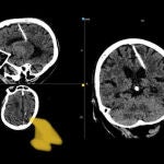 Descubren una aguja de 3 cm en el cerebro de una anciana rusa de 80 años