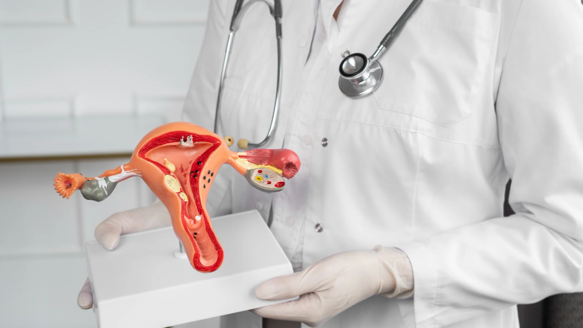 cancer cuello útero cérvix