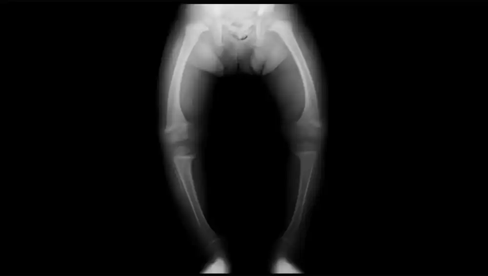 Gizard A, Rothenbuhler A, Pejin Z, Finidori G, Glorion C, de Billy B, Linglart A, Wicart P. Outcomes of orthopedic surgery in a cohort of 49 patients with X-linked hypophosphatemic rickets (XLHR). Endocr Connect. 2017 Nov;6(8):566-573. doi: 10.1530/EC-17-0154.