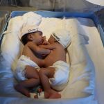 Las siamesas están unidas por su abdomen y comparten un único cordón umbilical