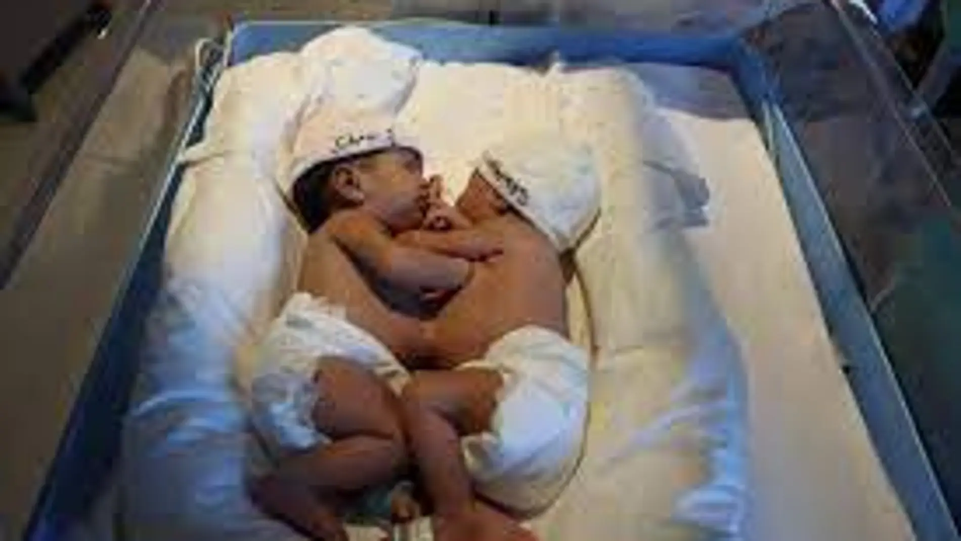 Las dos hermanas siamesas, Khadija y Cherive