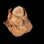 El tumor descubierto