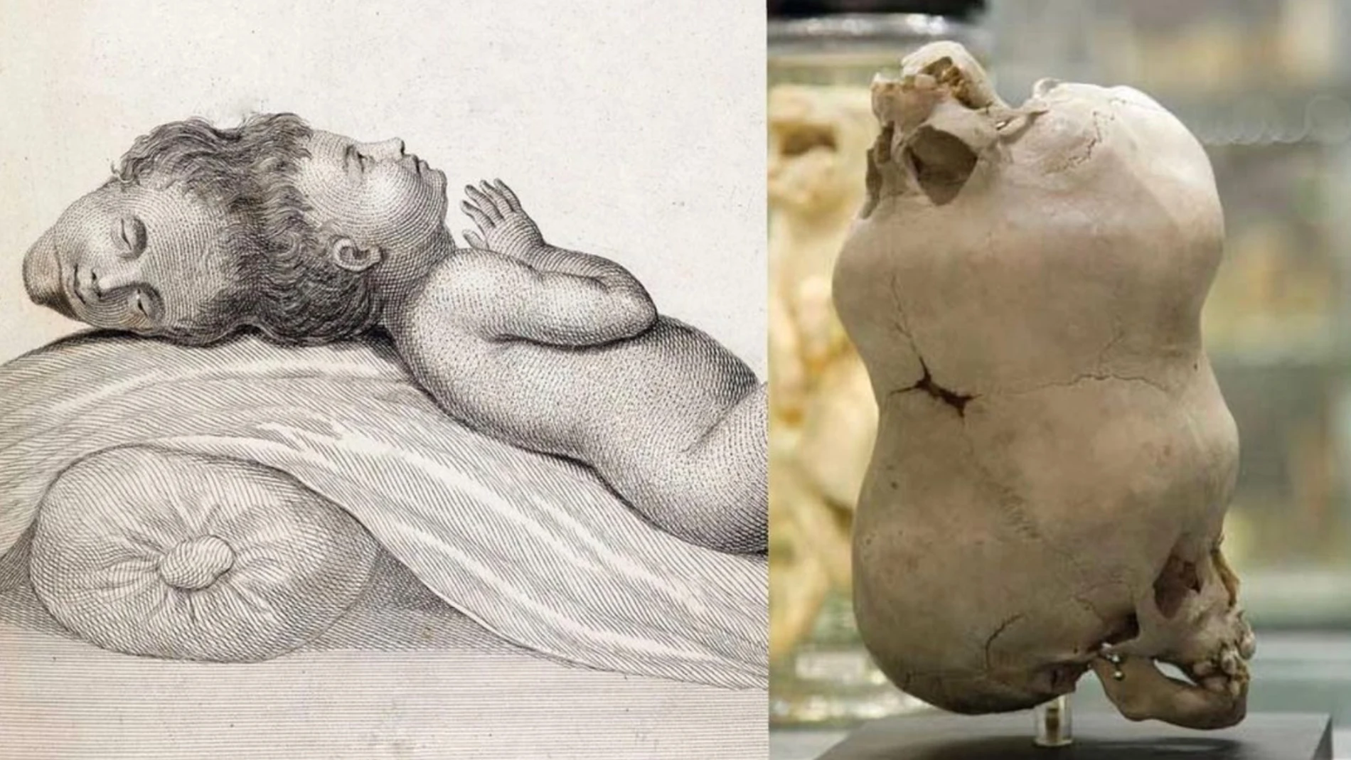 Cráneo de niño con dos cabezas