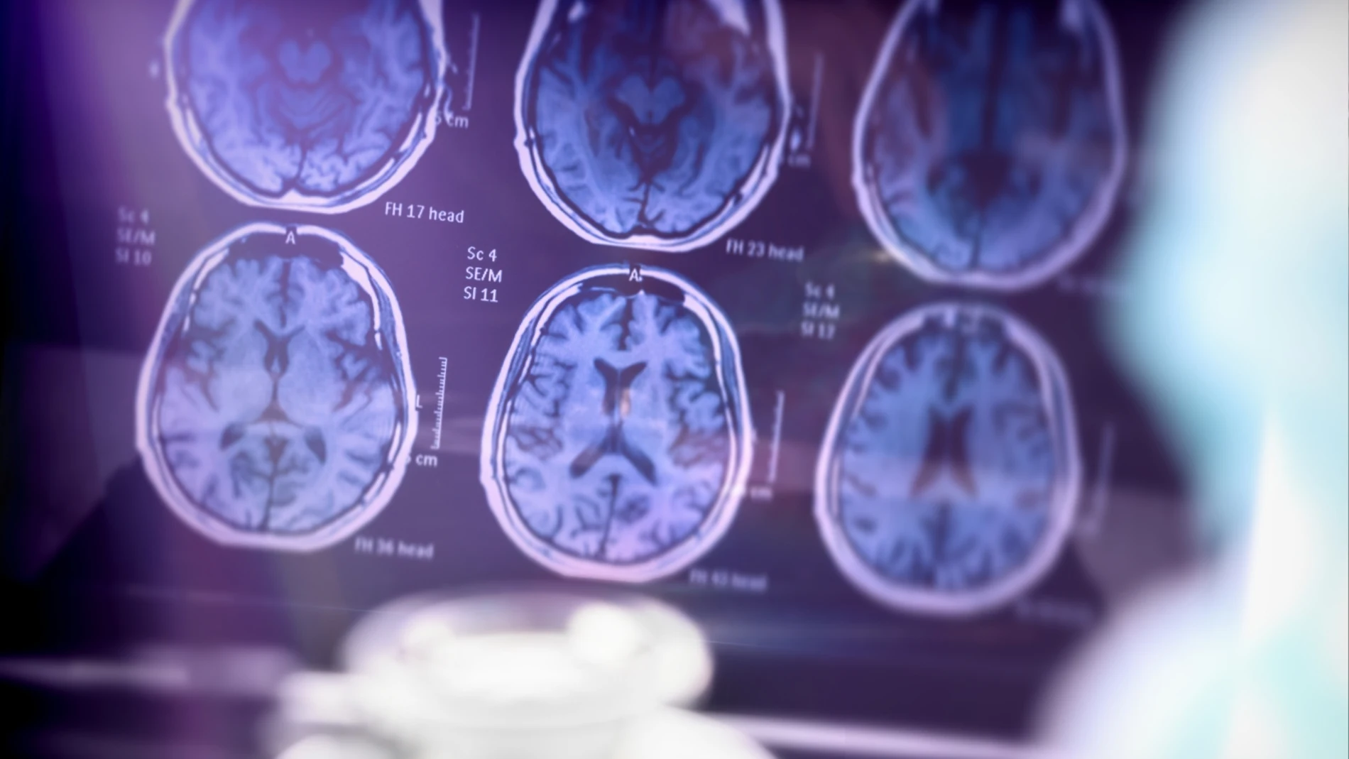 Científicos holandeses descubren cinco variantes del Alzheimer