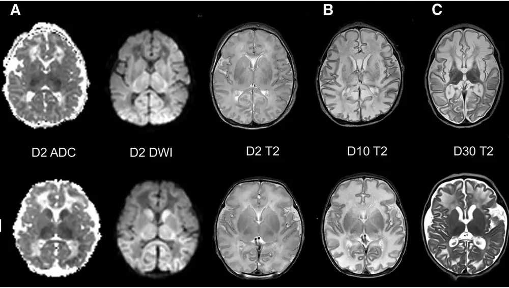 En la línea de abajo, efectos del sildenafil en el cerebro de los bebés