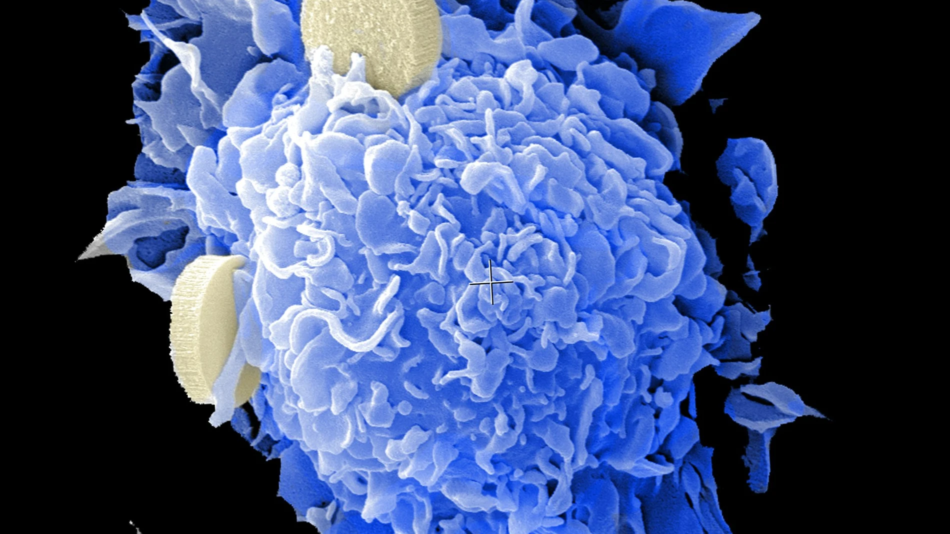 cáncer próstata