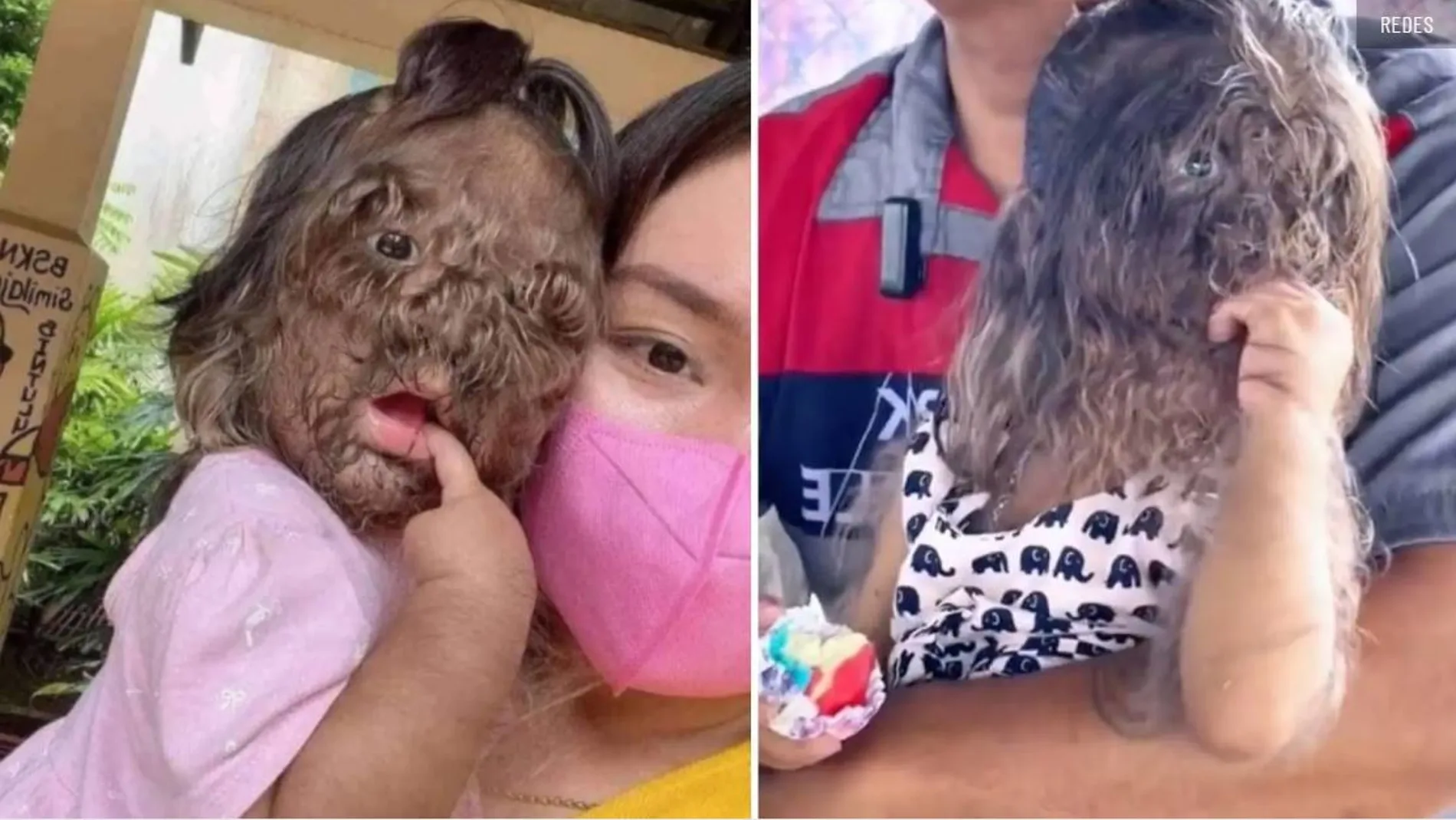 La extraña enfermedad de Adik Missclyen, conocida como hipertricosis, ha dado la vuelta al mundo