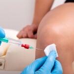 Inyección de plasma en la rodilla de una mujer