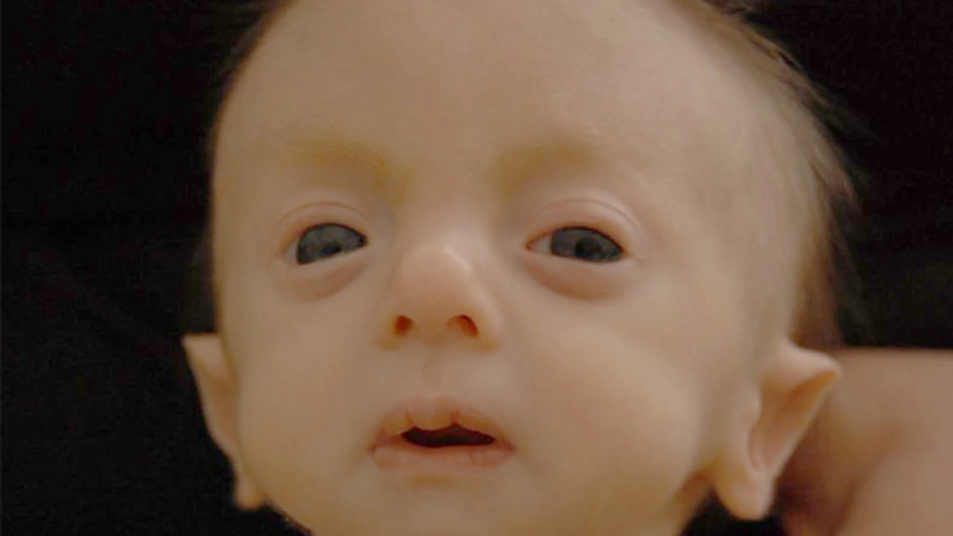 Un niño con Síndrome de Edwards