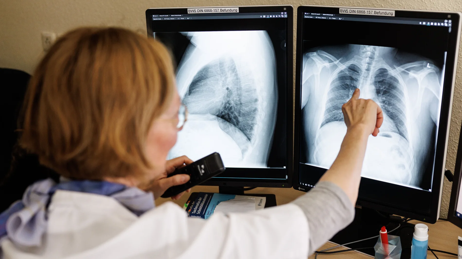 Se estima que una cuarta parte de la población mundial tiene infección tuberculosa latente