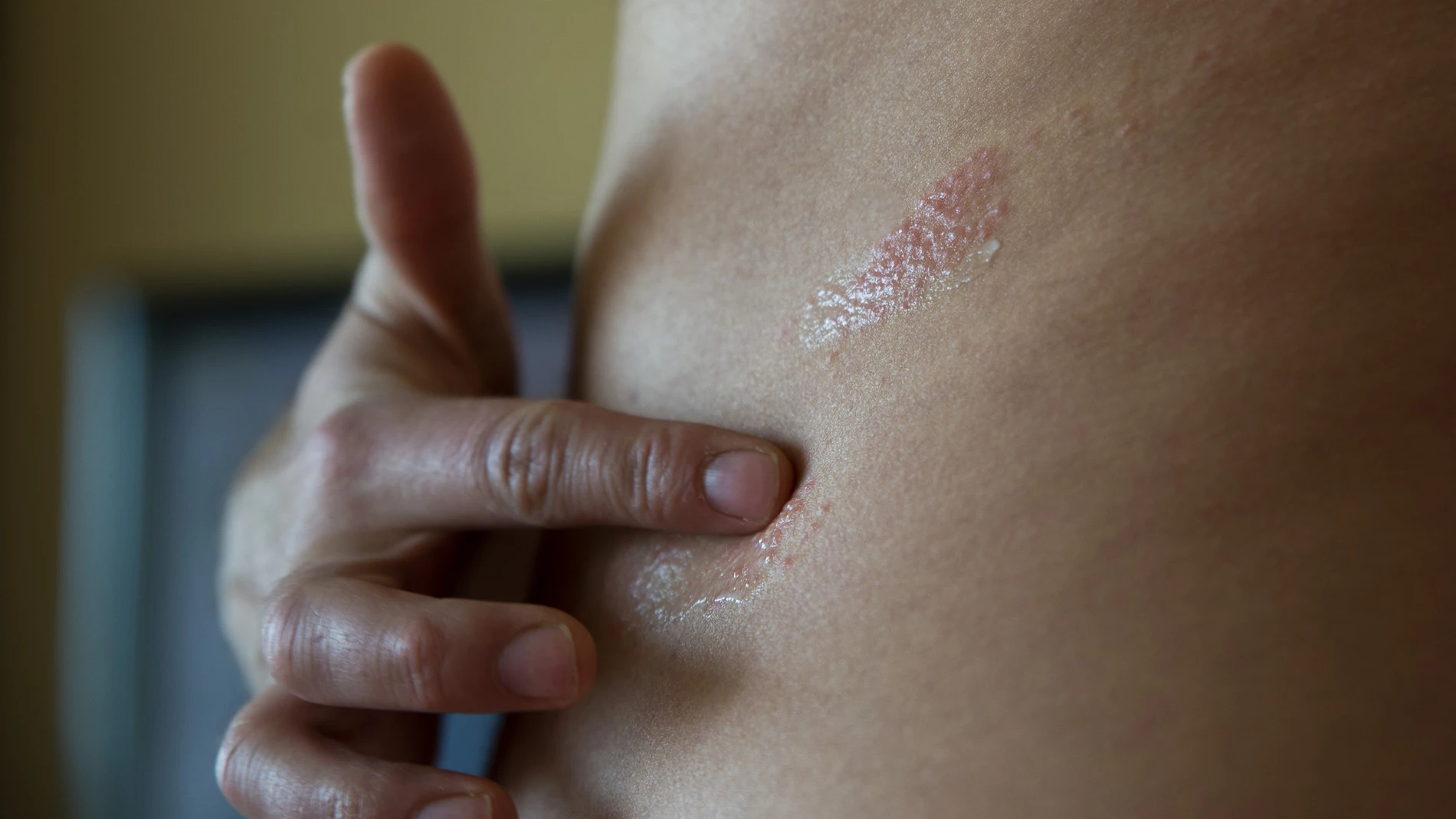 Herpes Zóster