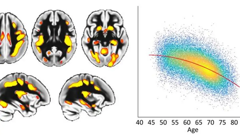 Curva de envejecimiento acelerado en estas regiones del cerebro