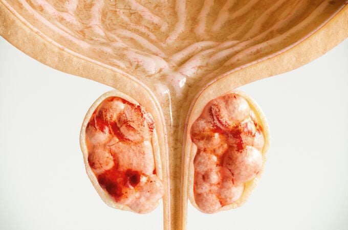 Cáncer de próstata Cáncer de próstata