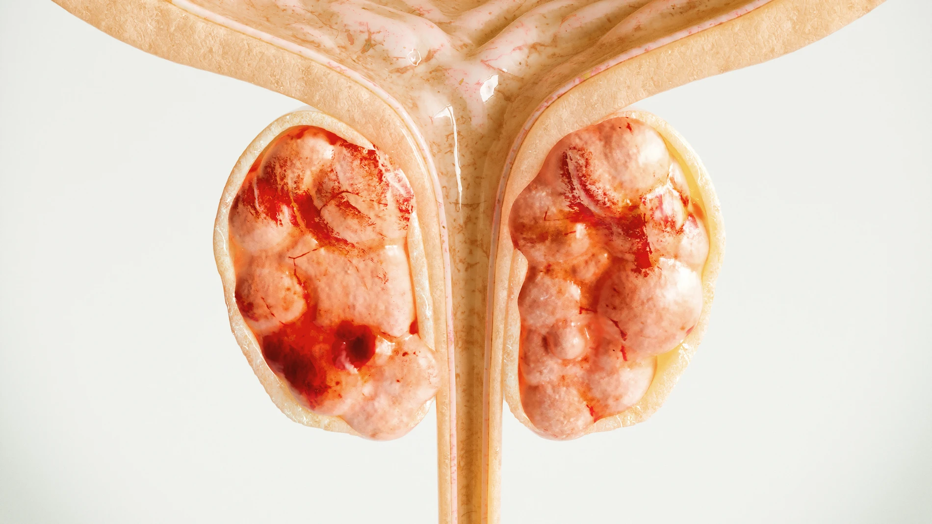 Cáncer de próstata