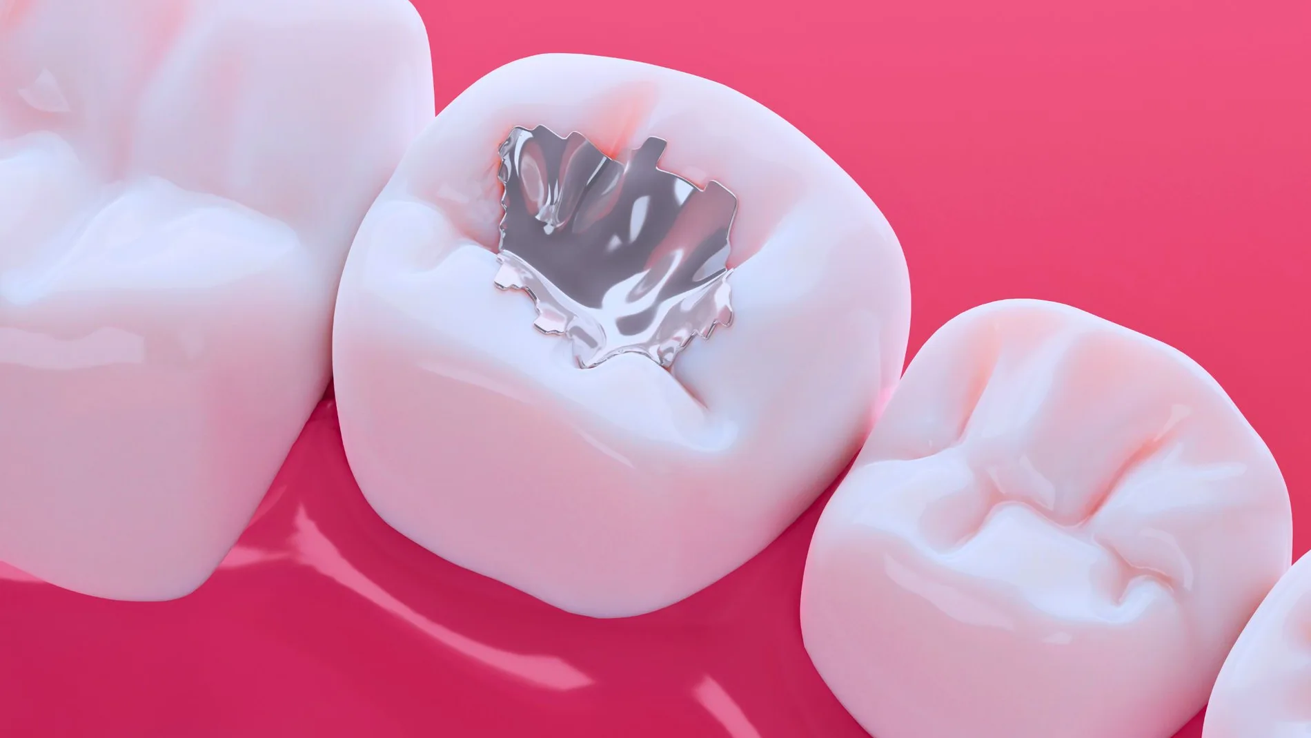 Dientes con amalgama dental que es mercurio riesgos salud prohibicion
