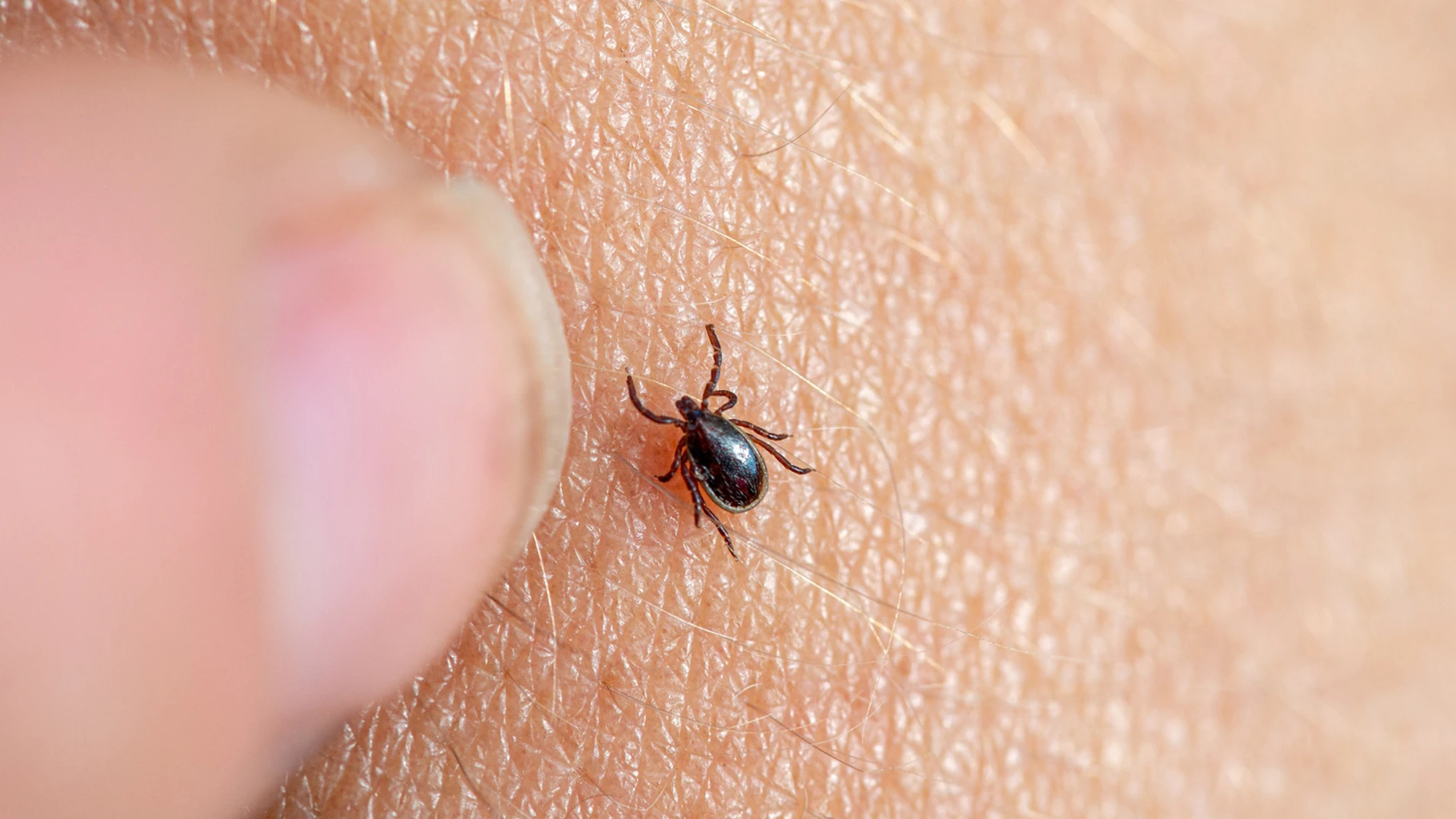 Imagen de una garrapata marrón en la piel humana con un dedo femenino a punto de retirarla. FUNDACIÓN SOS LYME (Foto de ARCHIVO) 24/05/2019