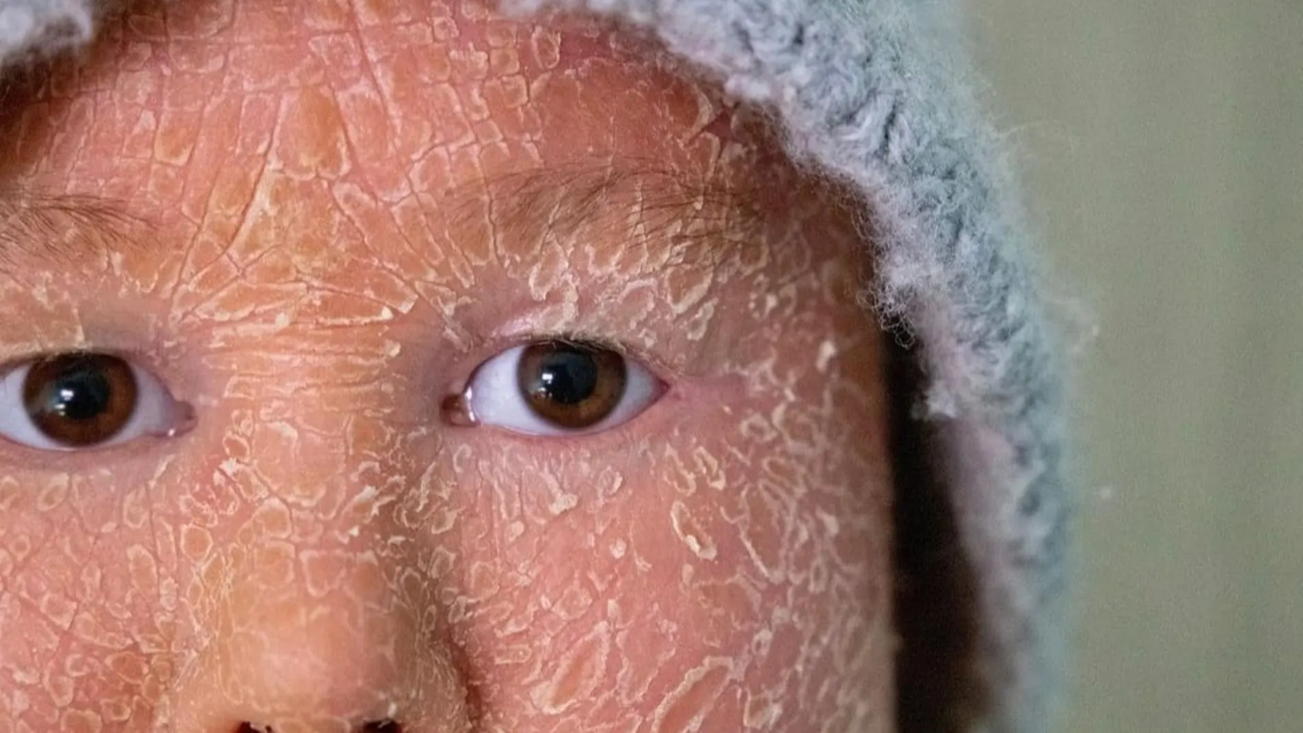 Niña con ictiosis
