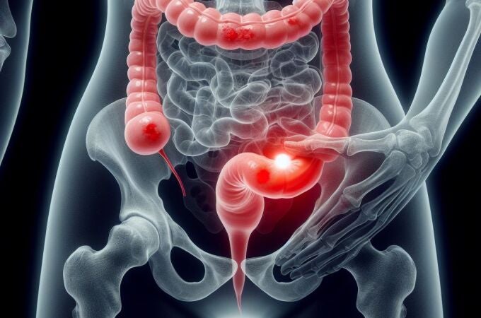 El cáncer colorrectal es el tumor maligno más frecuente en España y el segundo en tasa de mortalidad 