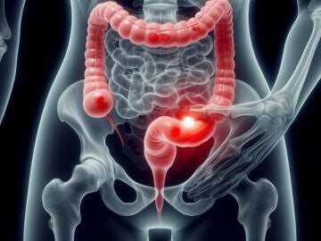 El c&aacute;ncer colorrectal es el tumor maligno m&aacute;s frecuente en Espa&ntilde;a y el segundo en tasa de mortalidad 