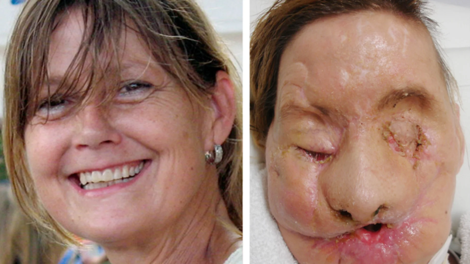 La brutalidad que sufrió Charla Nash a manos del chimpancé fue tan extrema que le desfiguró la cara por completo