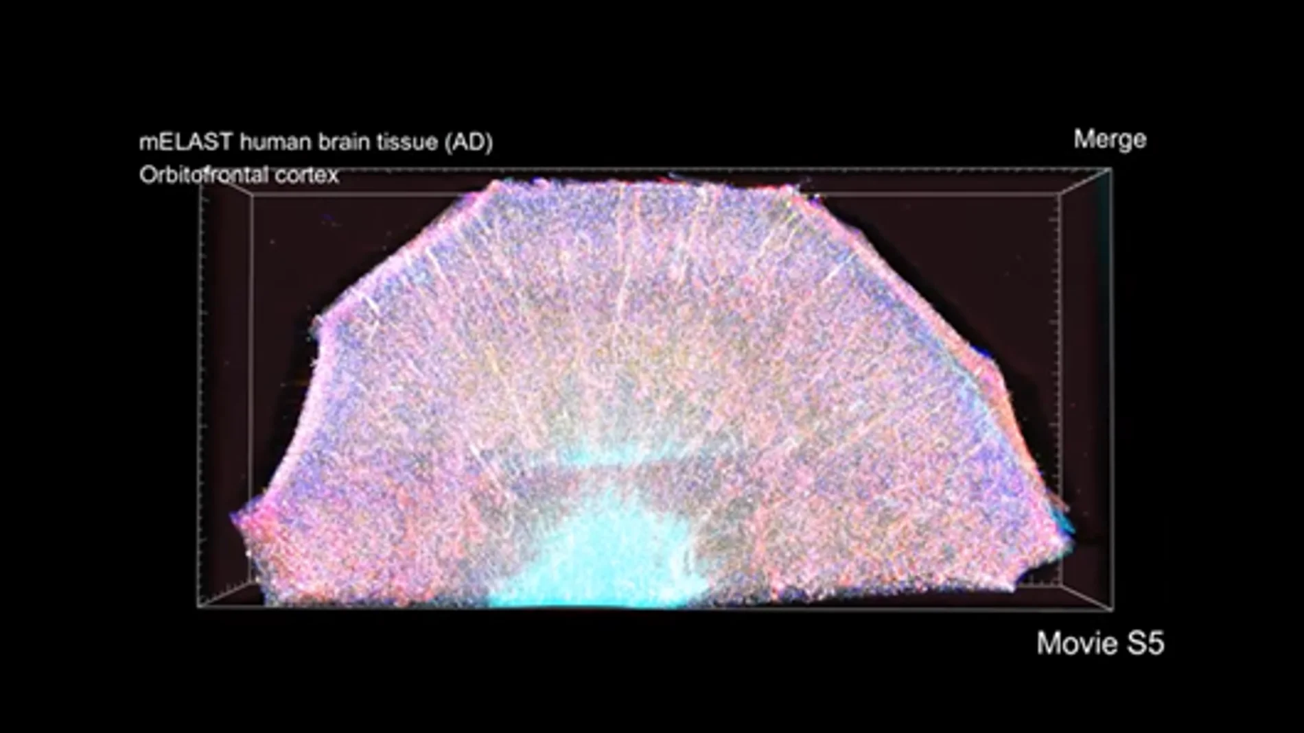 Numerosos anticuerpos marcan los componentes celulares y moleculares (en distintos colores) dentro de la corteza orbitofrontal de un donante cerebral con enfermedad de Alzheimer.