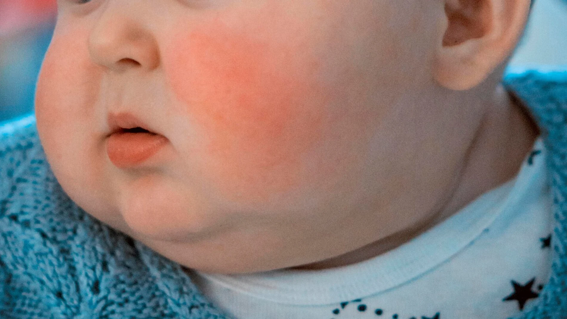 Un niño con la enfermedad del 'virus de la bofetada'.