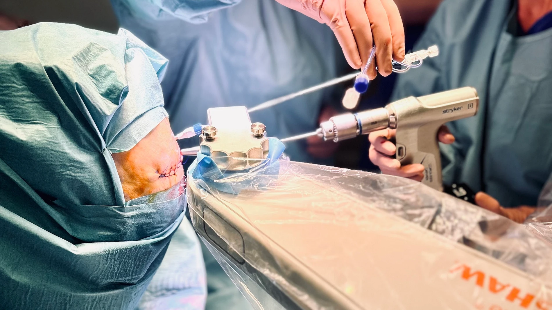 El Hospital del Mar realiza la "primera" intervención de cirugía láser para tratar con una ablación termal un gliobastoma en España HOSPITAL DEL MAR 19/06/2024