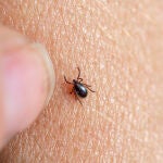 Imagen de una garrapata marrón en la piel humana con un dedo femenino a punto de retirarla.