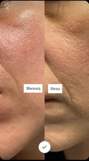 Efectos visibles del uso del Retinol 