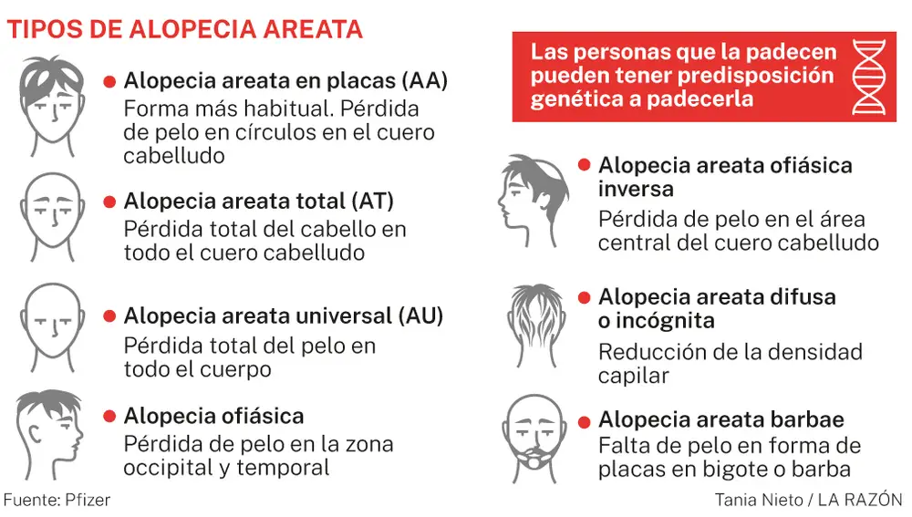 Alopecia areata
