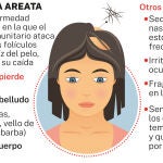 Alopecia Areata