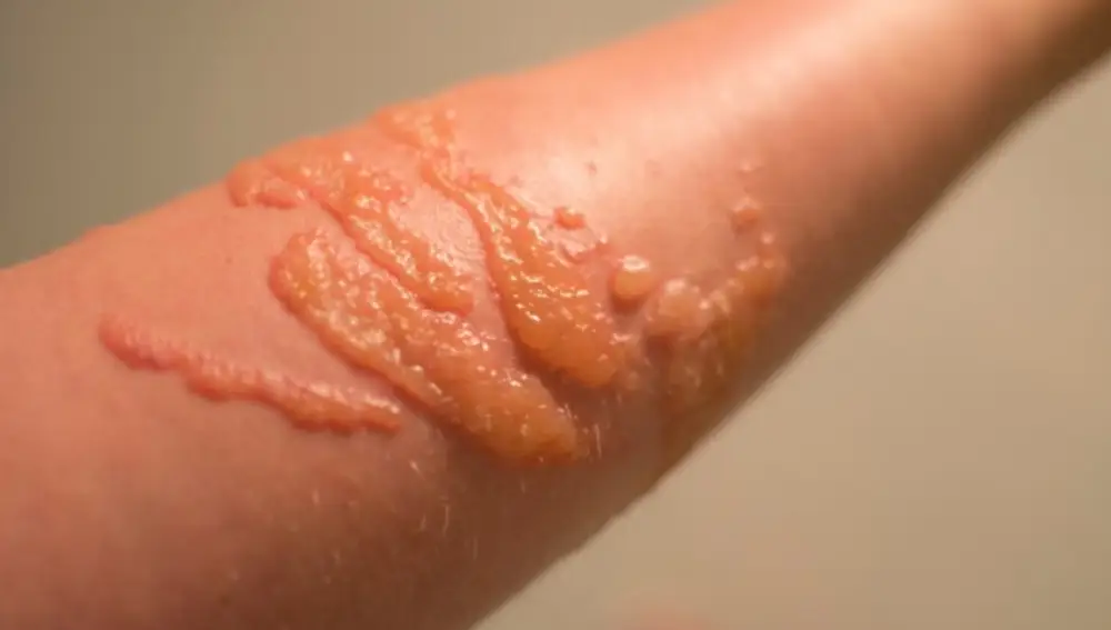 Qué hacer en caso de una picadura de medusa: prevención y tratamientos básicos