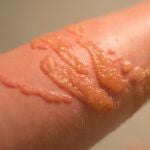 Qué hacer en caso de una picadura de medusa: prevención y tratamientos básicos