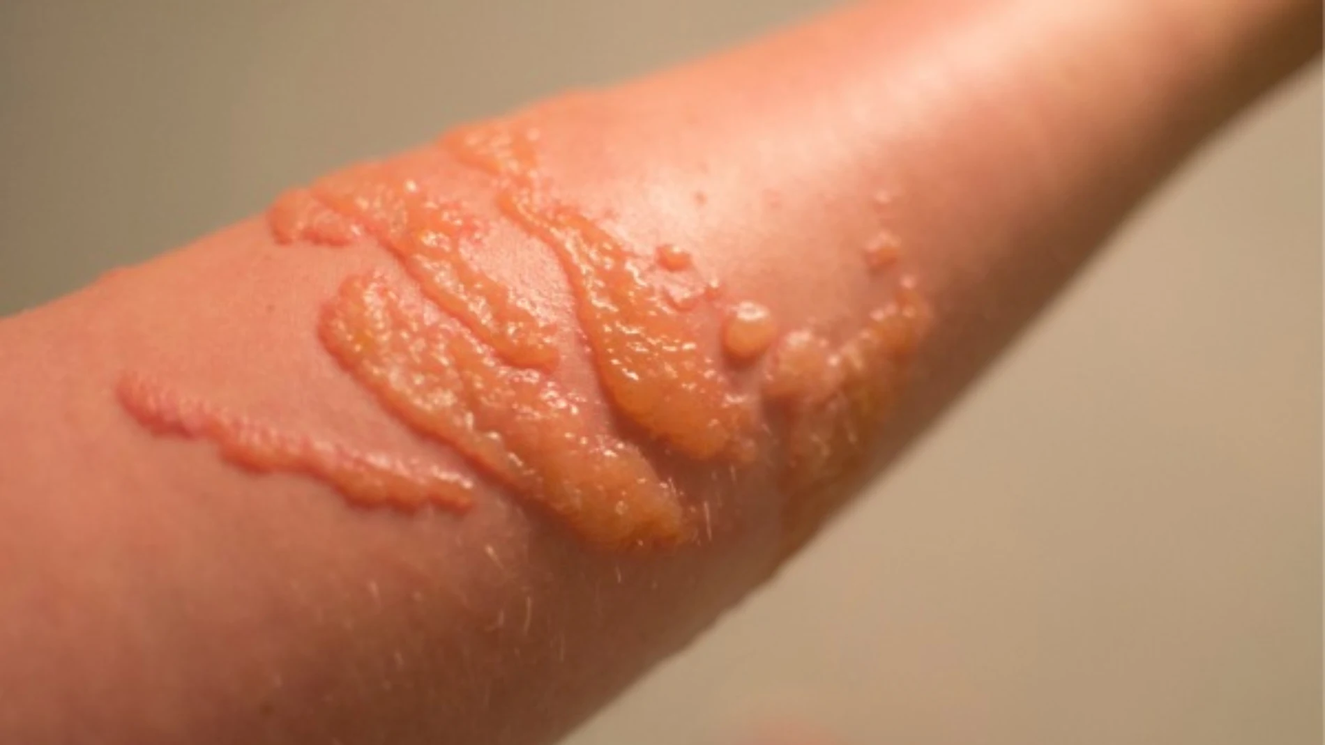 Qué hacer en caso de una picadura de medusa: prevención y tratamientos básicos