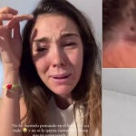 Anna Ferrer Padilla y la garrapata que le picó