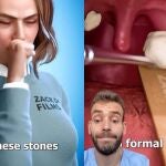 Un enfermero explica en TikTok qué son los tonsilolitos y cómo tratarlos