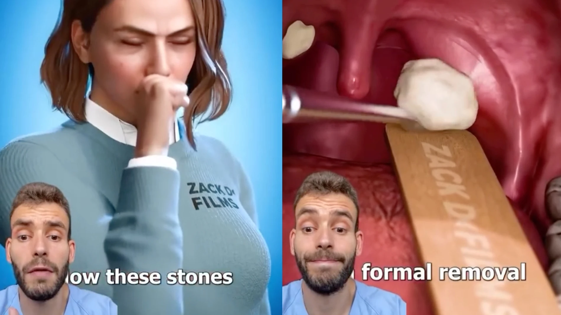 Un enfermero explica en TikTok qué son los tonsilolitos y cómo tratarlos