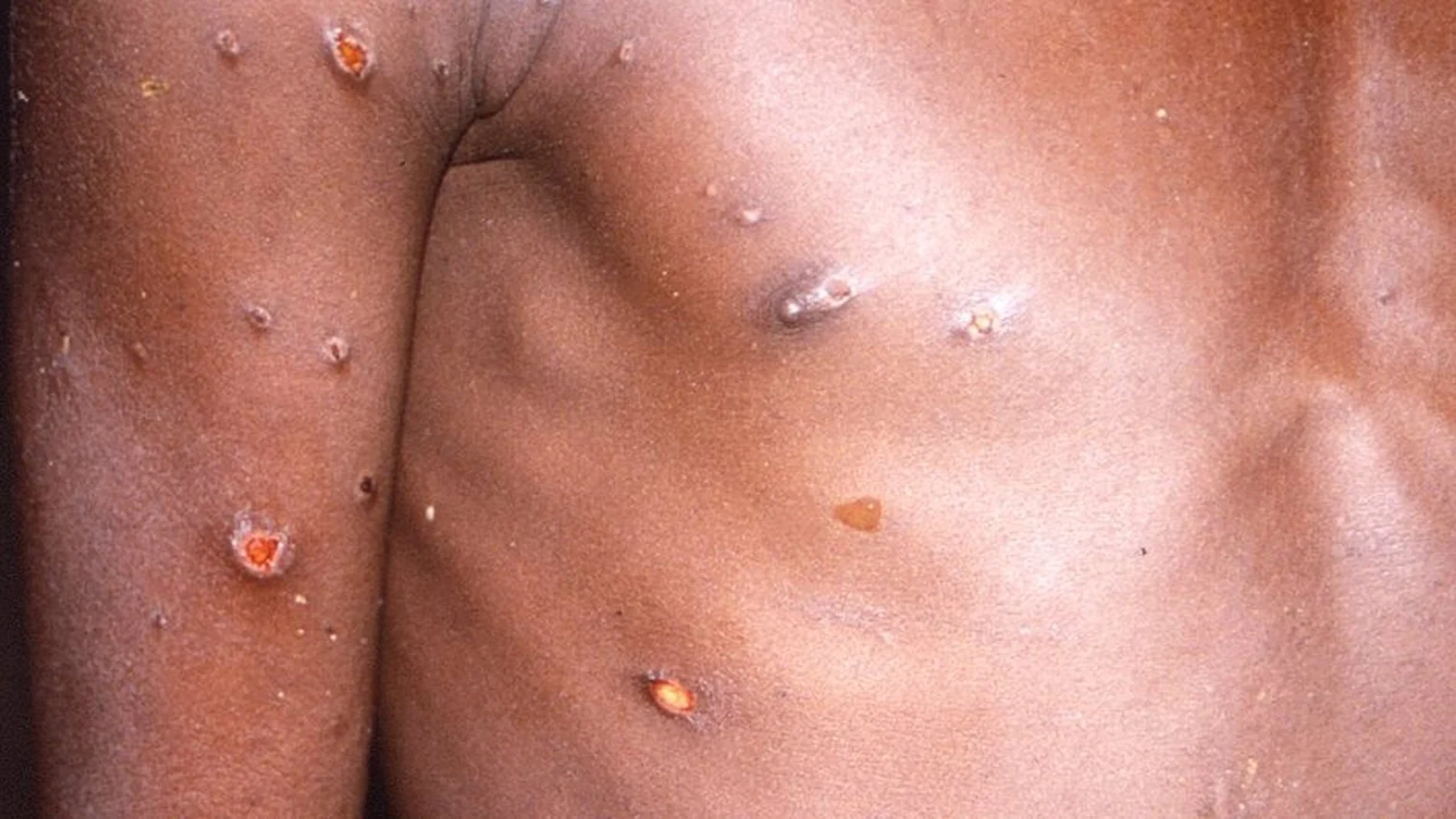 Salud.- La OMS notifica 934 casos de viruela del mono en junio en todo el mundo, casi un 50% más que en mayo