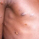 AMP.- África declara la emergencia de salud pública continental por el brote de mpox