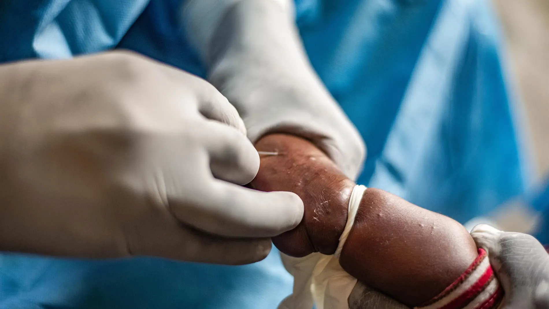 AMP.- Salud.- La Unión Africana confirma más de 540 muertos y 18.700 casos de mpox en África desde principios de año