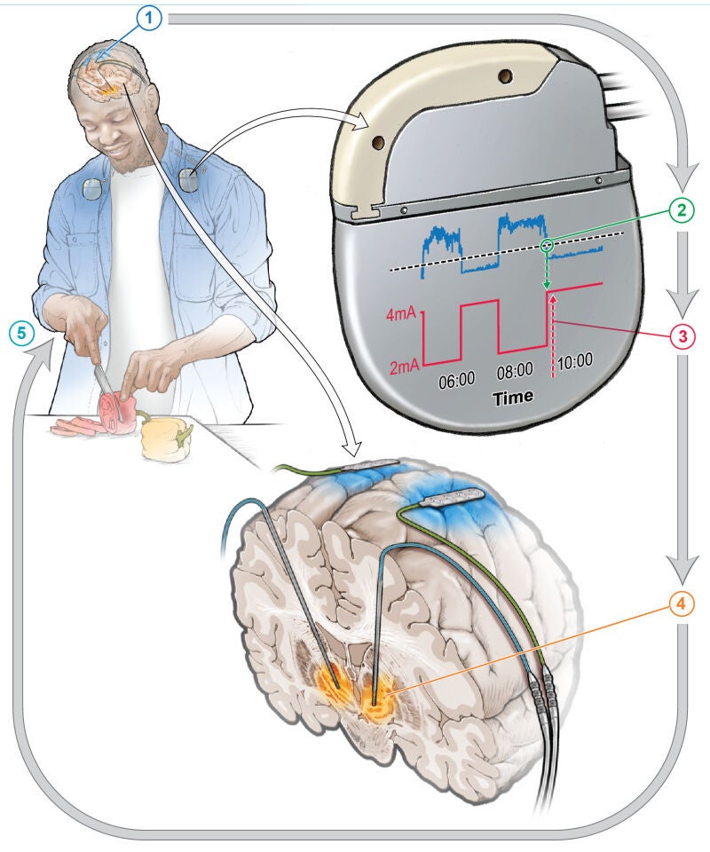 Dispositivo de estimulación cerebral profunda