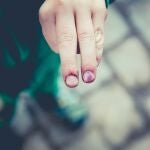 Persona con un hematoma subungueal en uno de los dedos de las manos