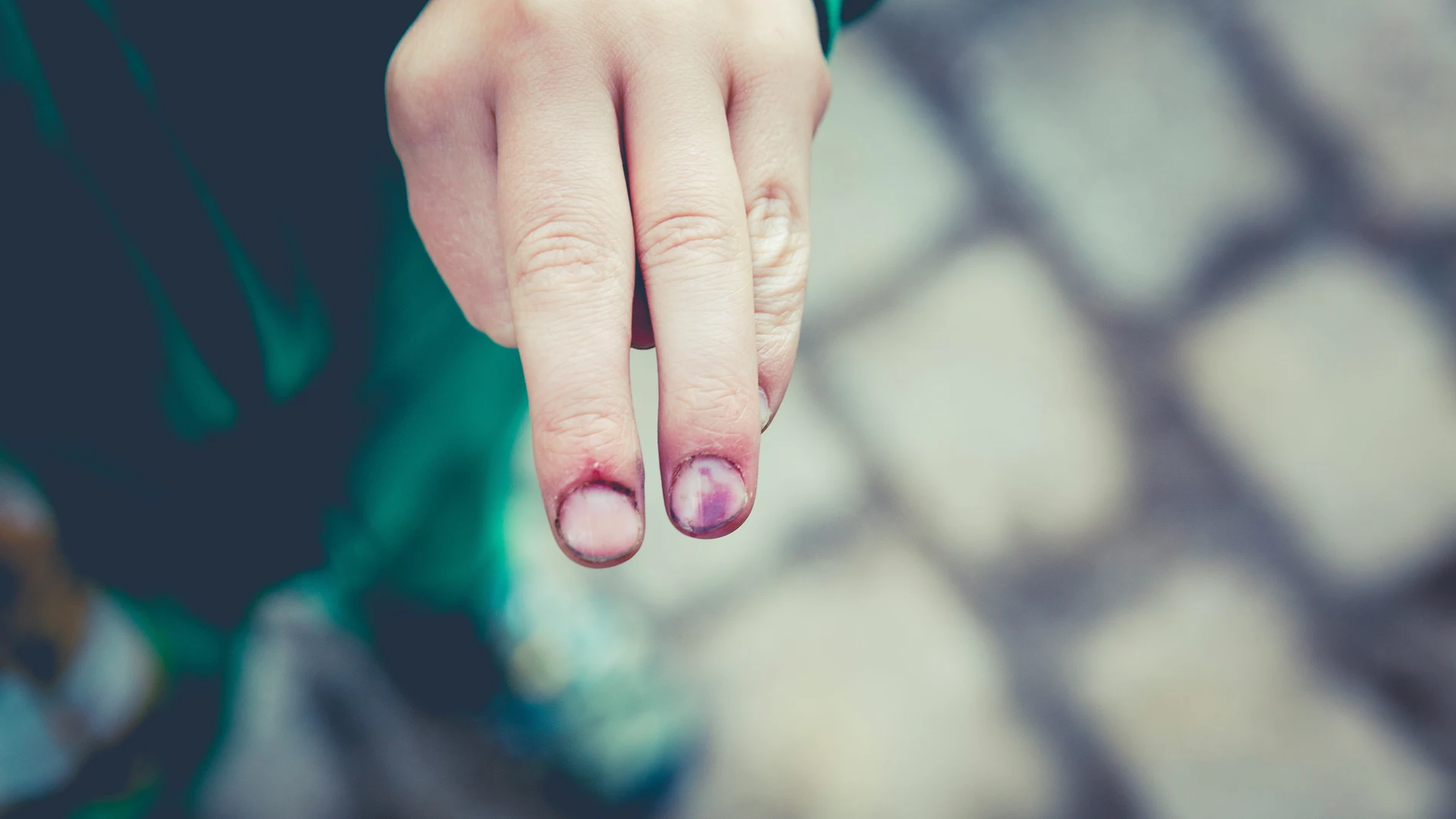 Persona con un hematoma subungueal en uno de los dedos de las manos